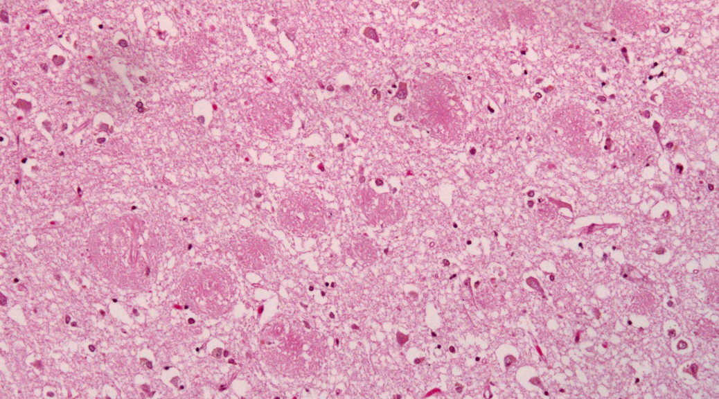 Amyloid plaques